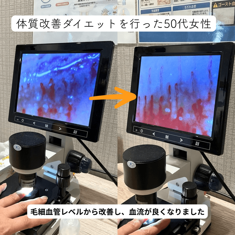 【50代女性の症例】体質改善ダイエットで毛細血管に変化！の施術前と施術後の比較