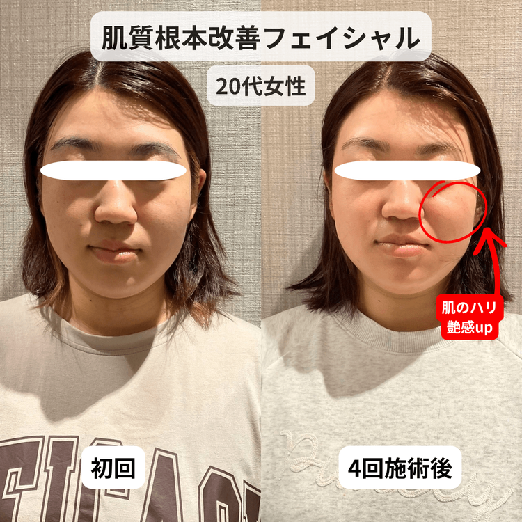 大人の肌質改善フェイシャルで目指すハリ・ツヤのあるお肌への施術前と施術後の比較
